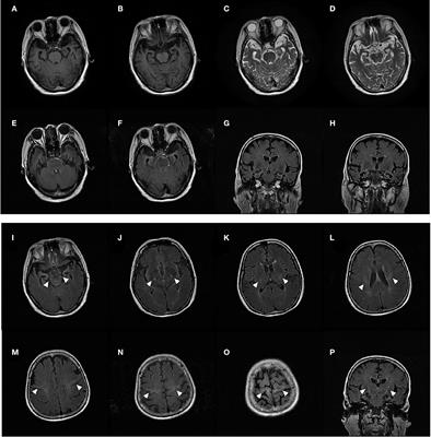 ANXA11 mutations are associated with amyotrophic lateral sclerosis–frontotemporal dementia